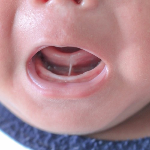 The Hidden Struggle: How Tongue Tie Affects Breastfeeding