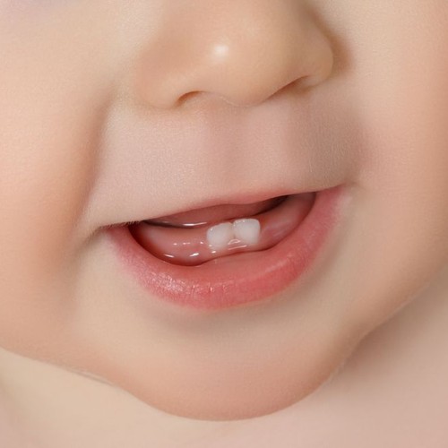 Dental Caries in the Sweet Embrace of Breastfeeding